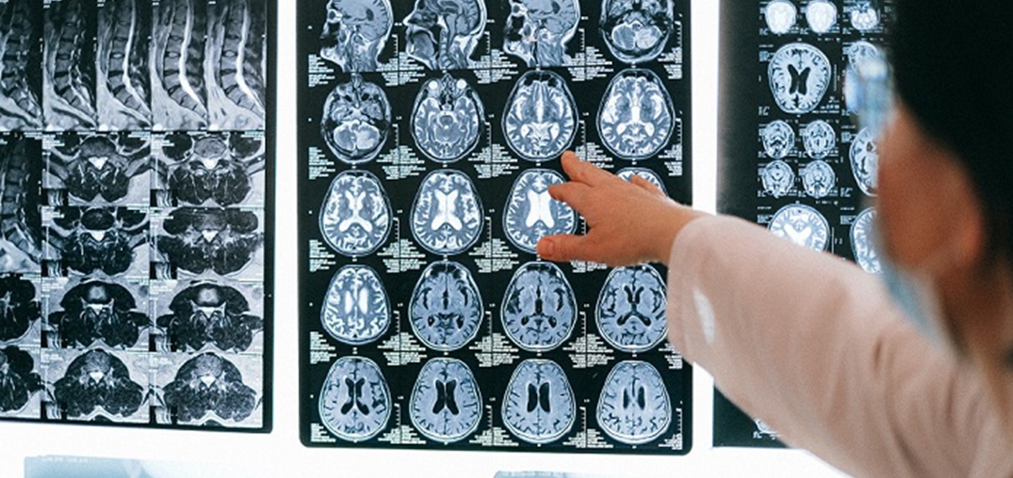 Sganiau'r ymennydd. Mae epilepsi yn gyflwr cyffredin sy'n effeithio ar o leiaf 600,000 o bobl yn y DU. Bydd y tîm yn defnyddio technoleg i astudio data dienw sydd eisoes wedi'i gasglu gan weithwyr gofal iechyd proffesiynol i wella a blaenoriaethu triniaethau.