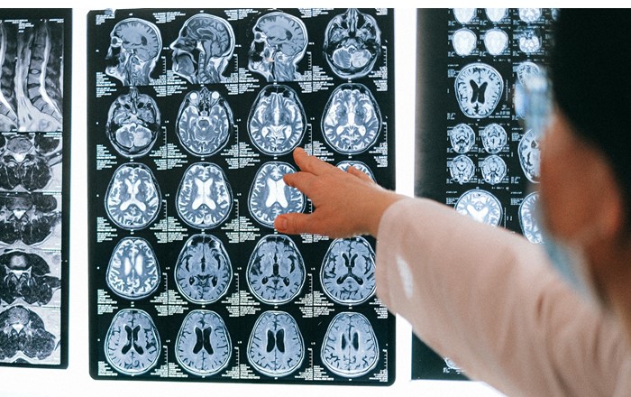 Brain scans: six Swansea University researchers have been awarded funding by Health and Care Research Wales, to investigate topics ranging from sun safety policies in primary schools to the impact of COVID-19 on people with epilepsy.