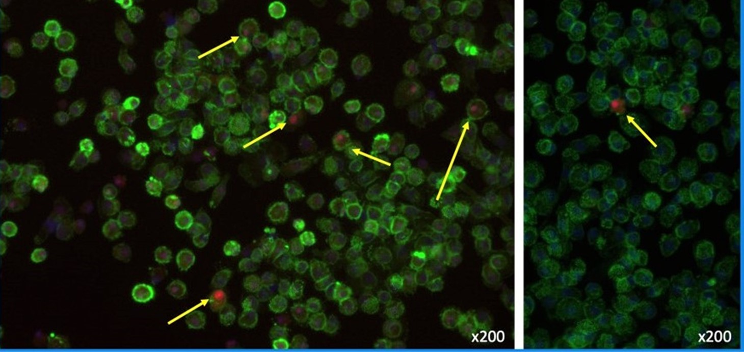 Left: white blood cells (coloured green and blue) isolated from human blood that have been fed with human myelin (red) to mimic myelin breakdown seen in MS. Arrows point to some cells which have ‘eaten’ the myelin. Right: the same cells after treatment