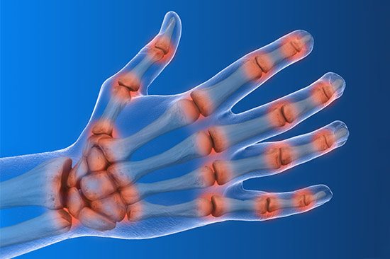 X ray of hands with rheumatoid arthritis with areas of pain shown in red.