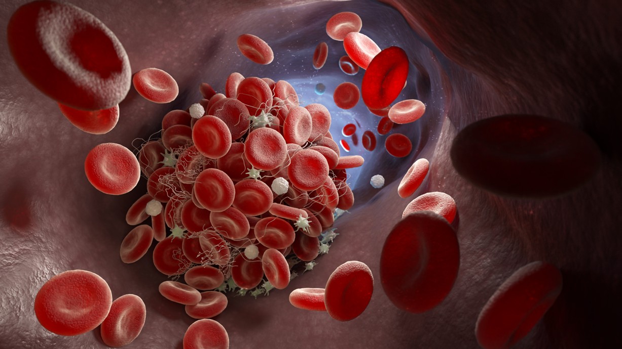 A 3D illustration depicting a blood clot forming inside a blood vessel.