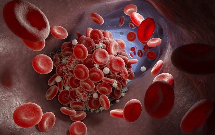 A 3D illustration depicting a blood clot forming inside a blood vessel.