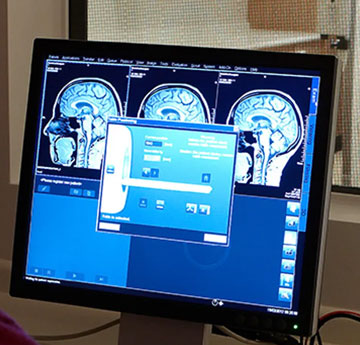 computer screen showing a brain scan